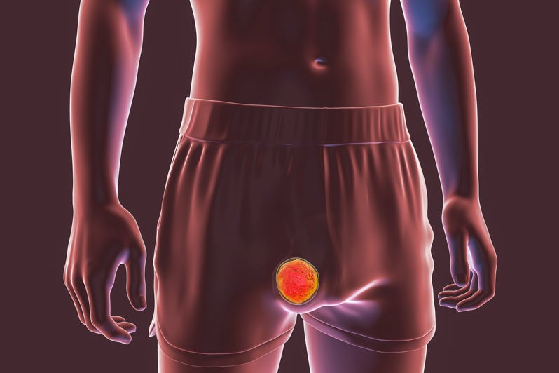 Rendering of testicular cancer