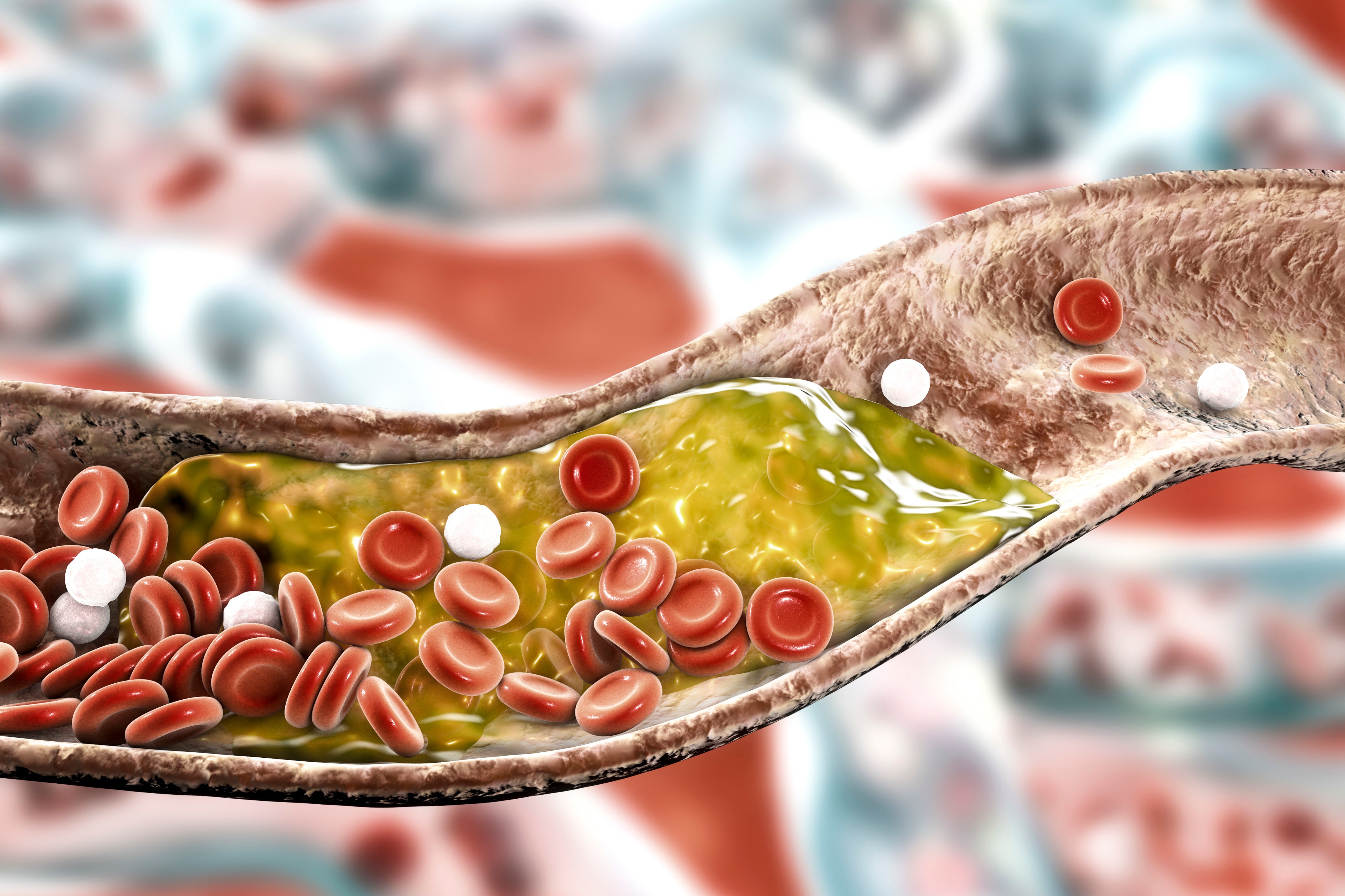 An illustration of cholesterol in an artery